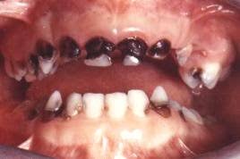 تعریف پوسیدگی دندان /علت پوسیدگی دندان /نشانه های پوسیدگی دندان/انواع پوسیدگی دندان و طبقه بندی ها یا انواع کلاس پوسیدگی /