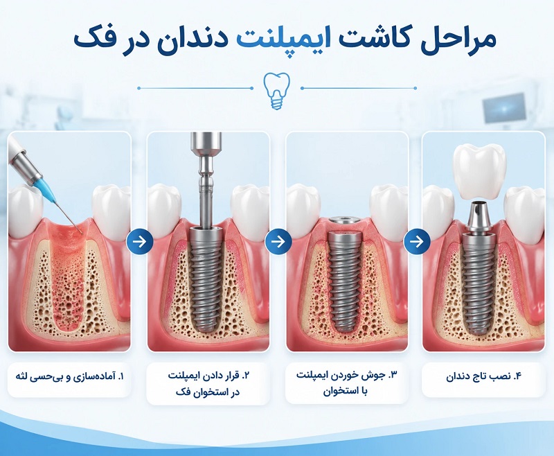 ایمپلنت دندان 3 مجموعه تخصصی دندانپزشکی من - ایمپلنت دندان