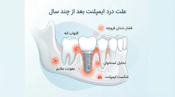 درد ایمپلنت دندان