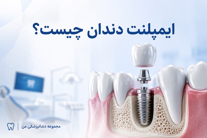 ایمپلنت دندان