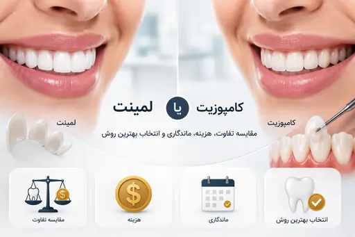 لمینت یا کامپوزیت