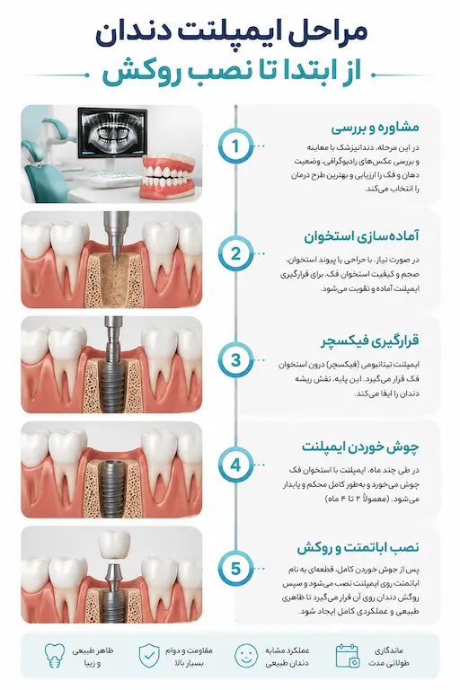ایمپلنت دندان 5 مراحل ایمپلنت دندان از مشاوره تا نصب روکش نهایی
