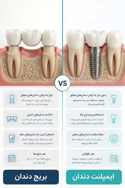 ایمپلنت دندان 11 مقایسه ایمپلنت دندان و بریج برای جایگزینی دندان از دست رفته