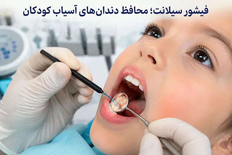 دندانپزشک کودکان 3 فیشور سیلانت برای محافظت از دندان آسیاب کودک