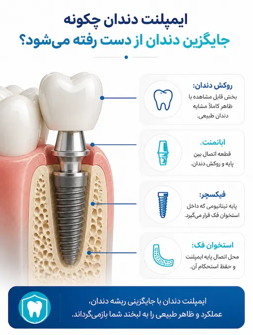 ایمپلنت دندان 1 اینفوگرافیک ایمپلنت دندان و اجزای تشکیل دهنده آن