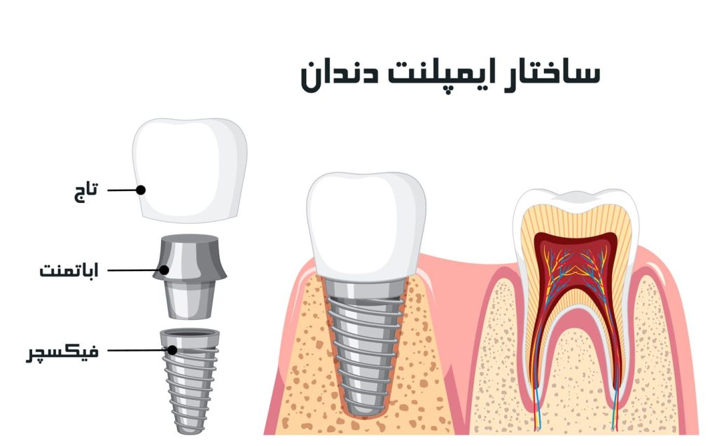 ایمپلنت دندان