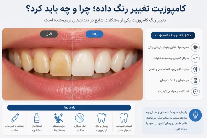 عوارض کامپوزیت دندان؛ آیا کامپوزیت برای دندان ضرر دارد؟ 4 تغییر رنگ کامپوزیت دندان
