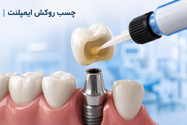 انواع روکش ایمپلنت