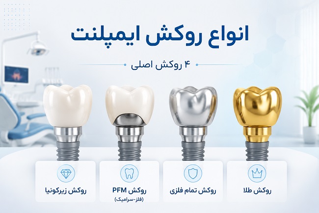 انواع روکش ایمپلنت