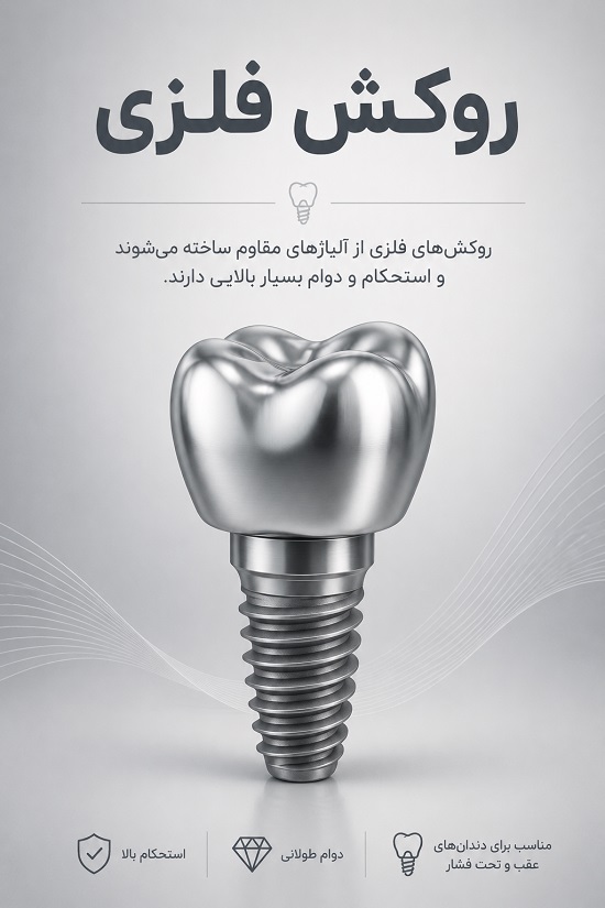 انواع روکش ایمپلنت