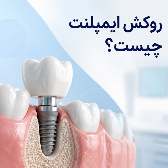 انواع روکش ایمپلنت