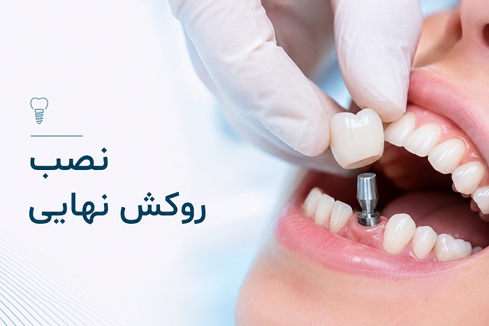 انواع روکش ایمپلنت