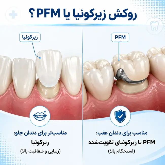روکش زیرکونیا یا PFM