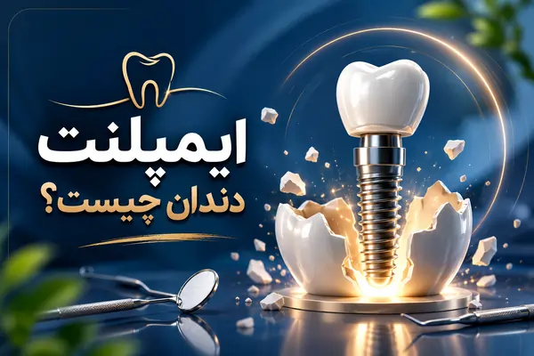 مجموعه تخصصی دندانپزشکی من - 10 مزایا و معایب ایمپلنت دندان که قبل از کاشت باید بدانید!