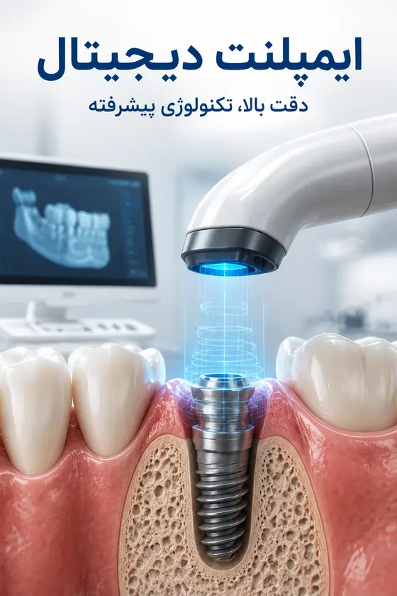 مزایا و معایب ایمپلنت