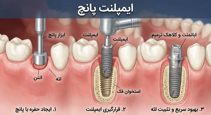 مجموعه تخصصی دندانپزشکی من - 10 مزایا و معایب ایمپلنت دندان که قبل از کاشت باید بدانید!