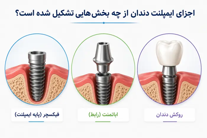 اجزای ایمپلنت دندان؛ معرفی کامل فیکسچر، اباتمنت و روکش دندان 2 اجزای ایمپلنت دندان