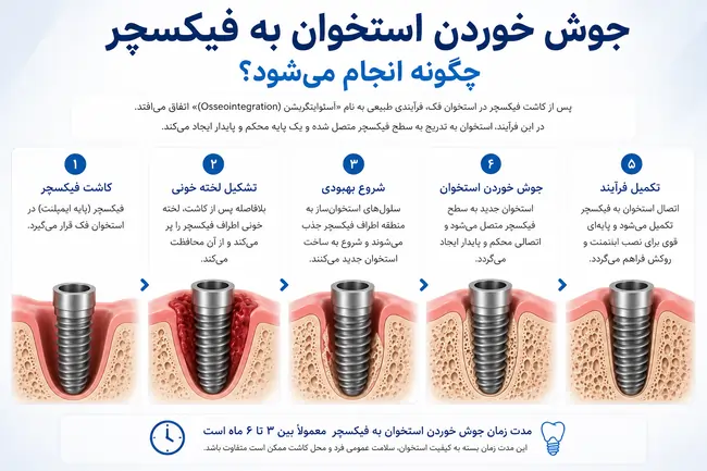 اجزای ایمپلنت دندان؛ معرفی کامل فیکسچر، اباتمنت و روکش دندان 3 اجزای ایمپلنت دندان