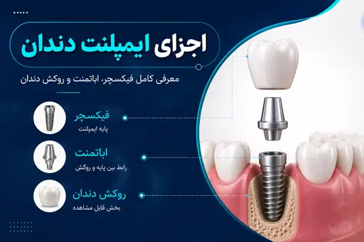 اجزای ایمپلنت دندان