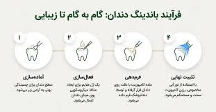 باندینگ دندان