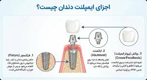 اجزای ایمپلنت دندان
