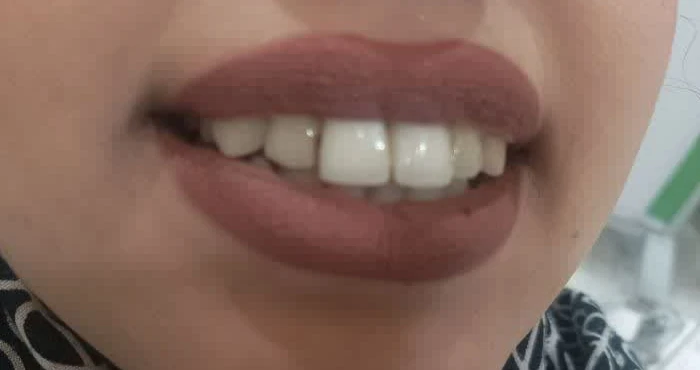 کاشت ایمپلنت
