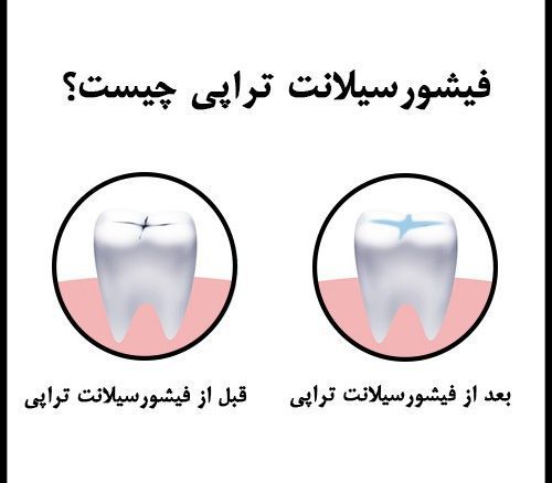 مشکلات دندان کودک