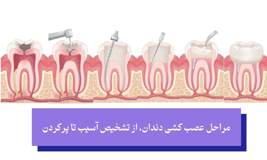 عصب کشی دندان شیری