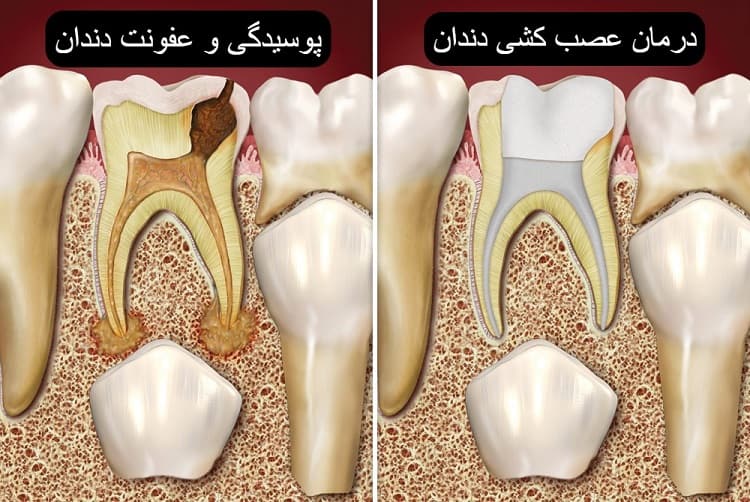 عصب کشی دندان شیری