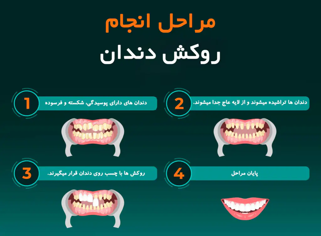 روکش دندان شیری اطفال