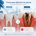 چه زمانی دندان قابل ترمیم نیست