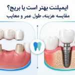 ایمپلنت بهتر است یا بریج