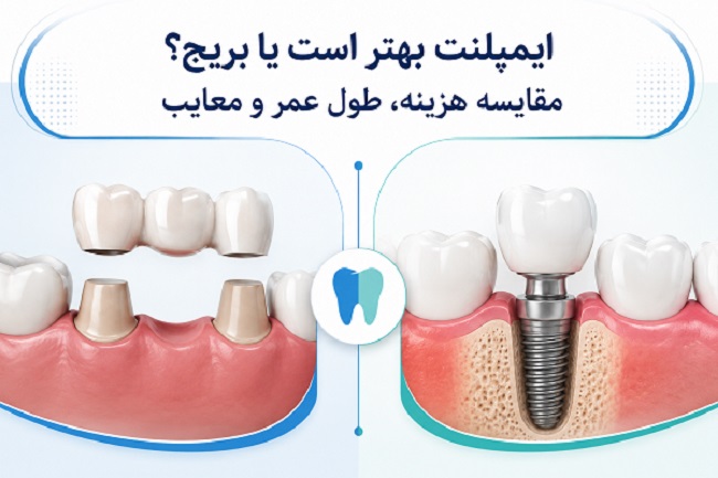 ایمپلنت بهتر است یا بریج؟ مقایسه هزینه، طول عمر و معایب