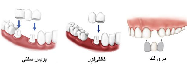 ایمپلنت بهتر است یا بریج