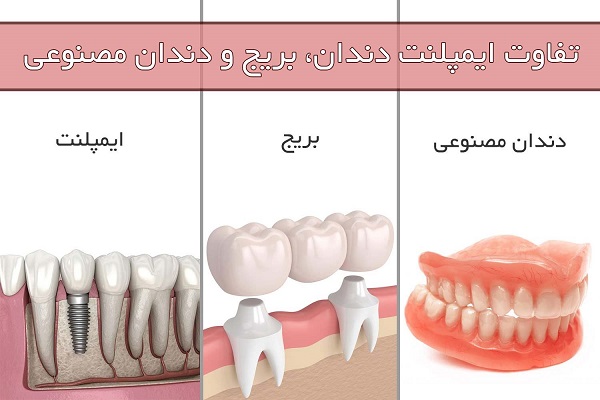 ایمپلنت بهتر است یا بریج