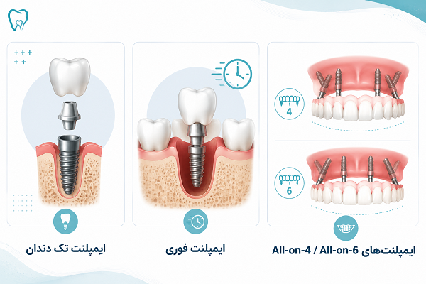 ایمپلنت بهتر است یا بریج