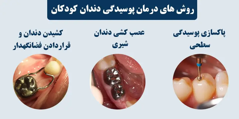 پوسیدگی دندان کودک