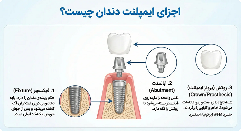 ایمپلنت دندان