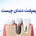ایمپلنت دندان