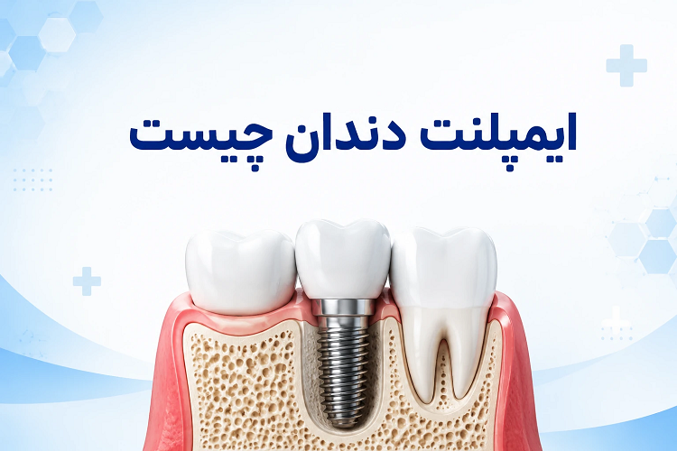ایمپلنت دندان چیست؟ مزایا، مراحل، عوارض و قیمت در ۱۴۰۵