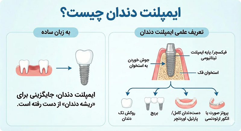 ایمپلنت دندان