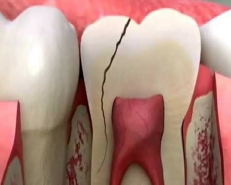 چه زمانی دندان قابل ترمیم نیست