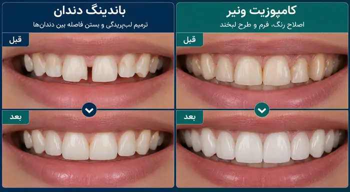 باندینگ دندان بهتر است یا کامپوزیت؟ مقایسه کامل تفاوت، مزایا، معایب، هزینه و ماندگاری در سال 1405 6 فرق باندینگ با کامپوزیت
