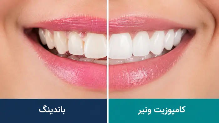 باندینگ دندان بهتر است یا کامپوزیت؟ مقایسه کامل تفاوت، مزایا، معایب، هزینه و ماندگاری در سال 1405 2 باندینگ دندان بهتر است یا کامپوزیت