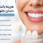 هزینه باندینگ دندان جلو