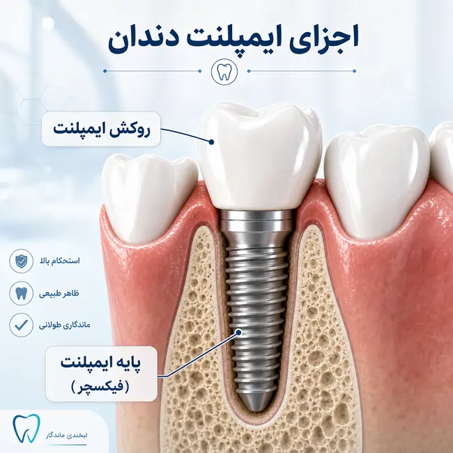 طول عمر ایمپلنت دندان