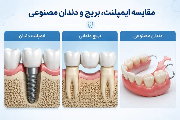طول عمر ایمپلنت دندان