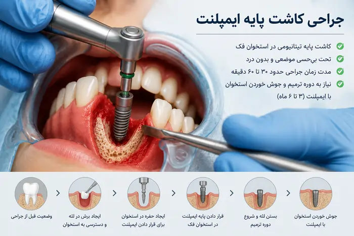 مراحل ایمپلنت دندان