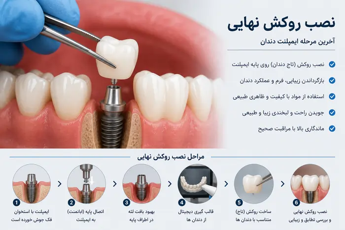 مراحل ایمپلنت دندان