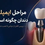 مراحل ایمپلنت دندان